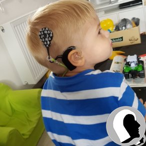 CI Kopf 2018 männlich Kind